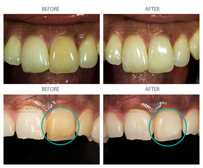 Teeth Bleaching