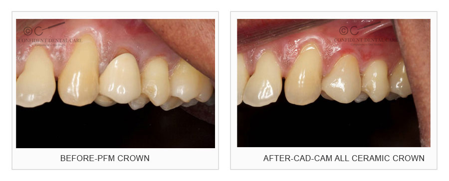 CAD-CAM (Crown)