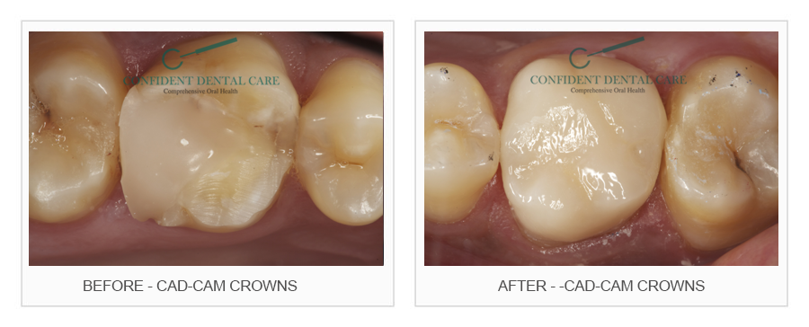 CAD-CAM (Crown)