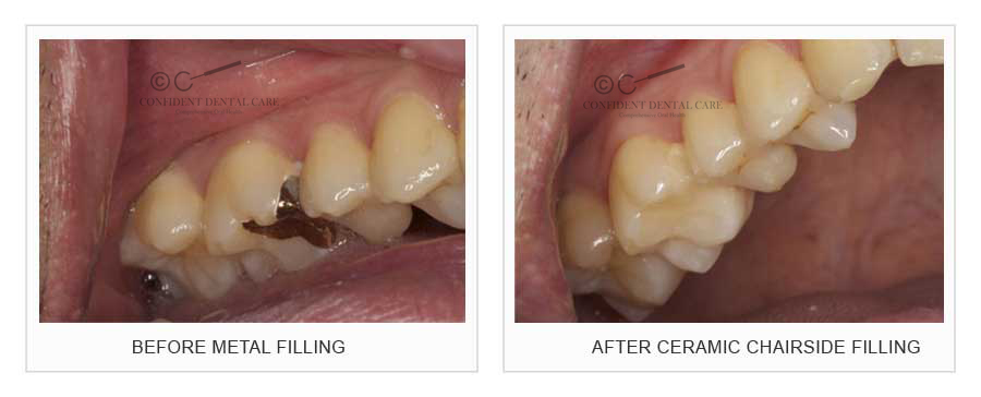CAD-CAM (Filling)