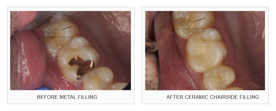 CAD-CAM (Filling)