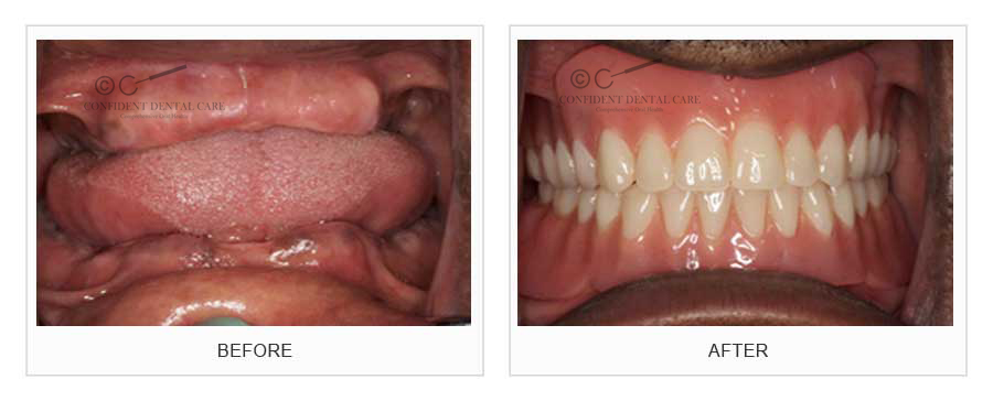 Complete Denture