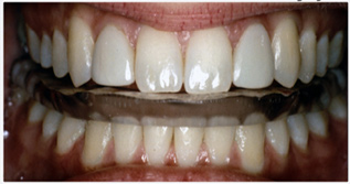 Dental Splint