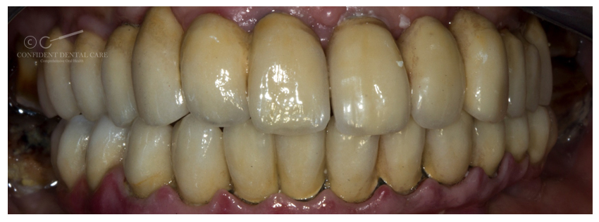 Full Mouth Implant Denture
