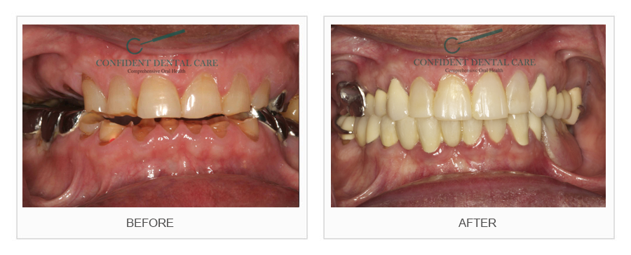 Full Mouth Rehabilitation