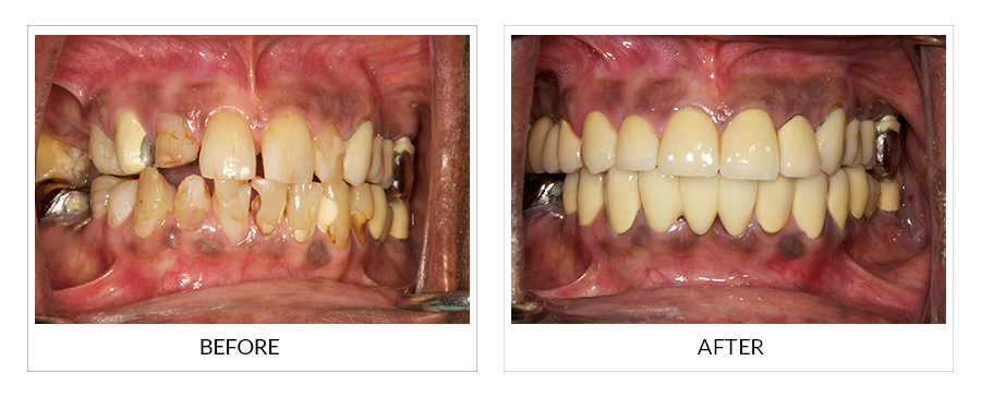 Full Mouth Rehabilitation