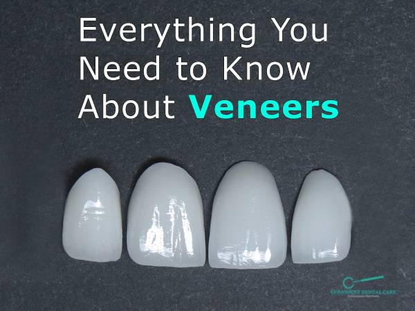 Everything you Need to Know about Veneers