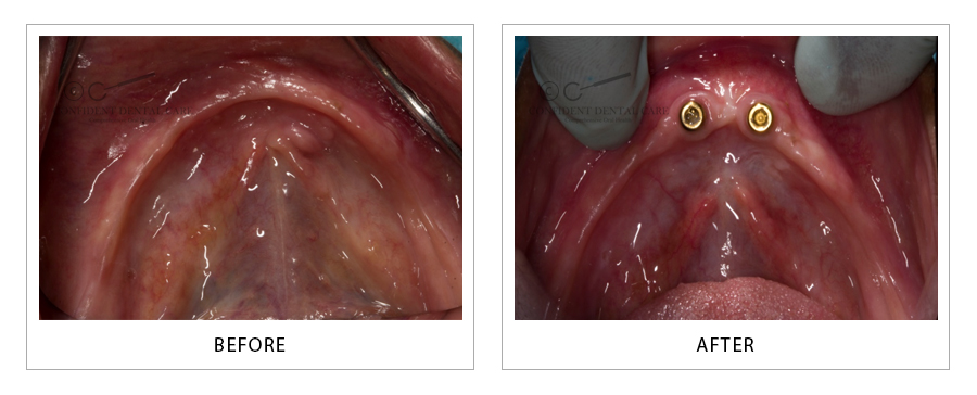 Over Denture