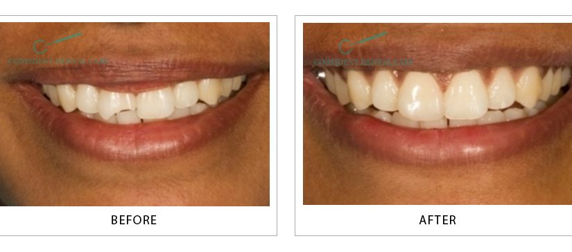 Tooth Color Fillings (Composite)