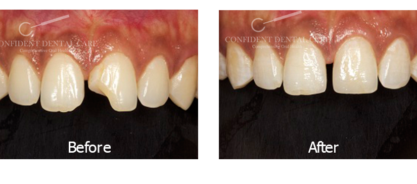 Tooth Color Fillings (Composite)